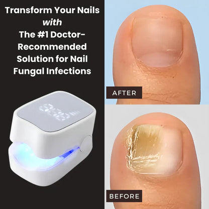 HalaHub™ - Nail Fungus Laser Device